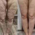LUMA Pro - Ultrasonic Body Toner & Cellulite Remover