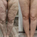 LUMA Pro - Ultrasoniq Body Toner & Cellulite Remover